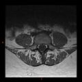 Normal spine MRI (Radiopaedia 77323-89408 Axial T1 18).jpg
