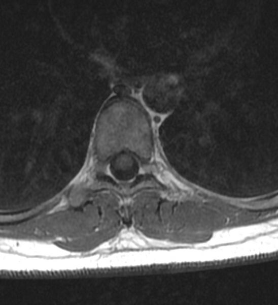 File:Normal thoracic spine MRI (Radiopaedia 41033-43781 Axial T1 5).jpg