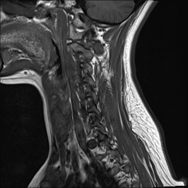 File:Normal trauma cervical spine MRI (Radiopaedia 32130-33071 Sagittal T1 3).jpg