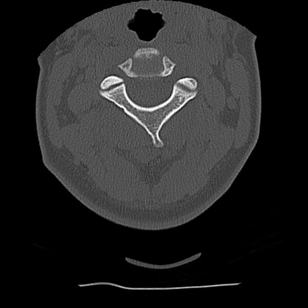 File:Normal trauma spine imaging (Radiopaedia 31753-32686 Axial bone window 24).jpg