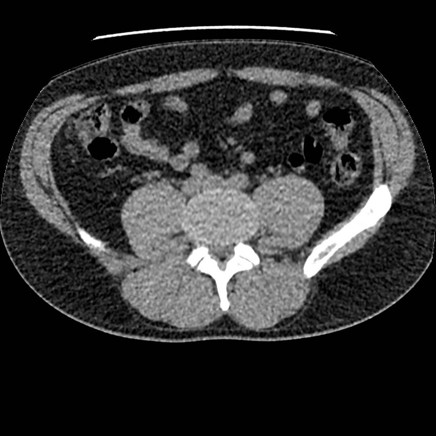 Obstructing ureteric calculus and ureteric anatomy (Radiopaedia 62730-71042 Axial non-contrast 92).jpg