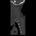 Occipital condyle fracture (Radiopaedia 31755-32691 Sagittal bone window 38).jpg