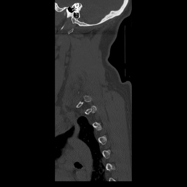 File:Occipital condyle fracture (Radiopaedia 31755-32691 Sagittal bone window 38).jpg
