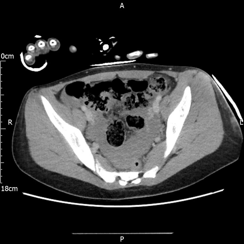 AAST grade IV kidney injury with CEUS follow-up (Radiopaedia 72353-82877 Axial C+ portal venous phase 63).jpg