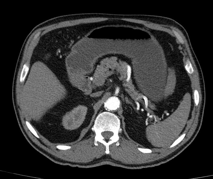 File:Abdominal aortic aneurysm (Radiopaedia 22421-22458 C+ arterial phase 17).jpg