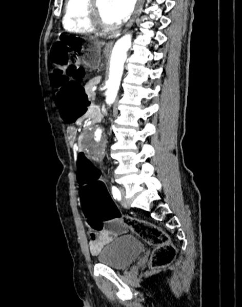 File:Abdominal aortic aneurysm (Radiopaedia 83581-98689 Sagittal C+ arterial phase 57).jpg