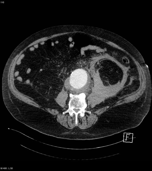 File:Abdominal aortic aneurysm with intramural hematoma then rupture (Radiopaedia 50278-55632 Axial C+ arterial phase 109).jpg