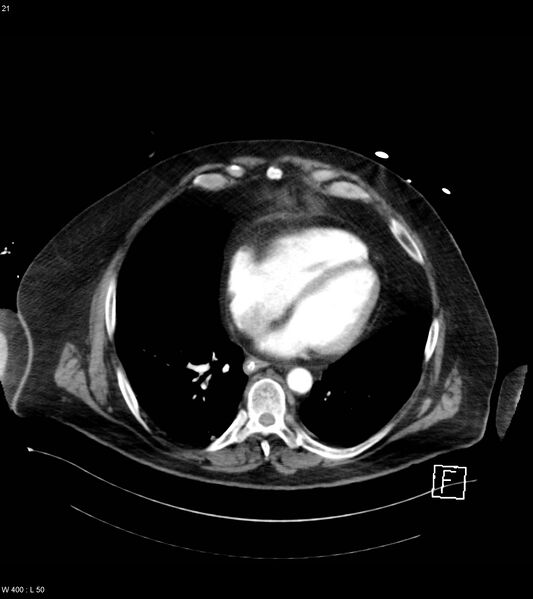 File:Abdominal aortic aneurysm with intramural hematoma then rupture (Radiopaedia 50278-55632 Axial C+ arterial phase 20).jpg