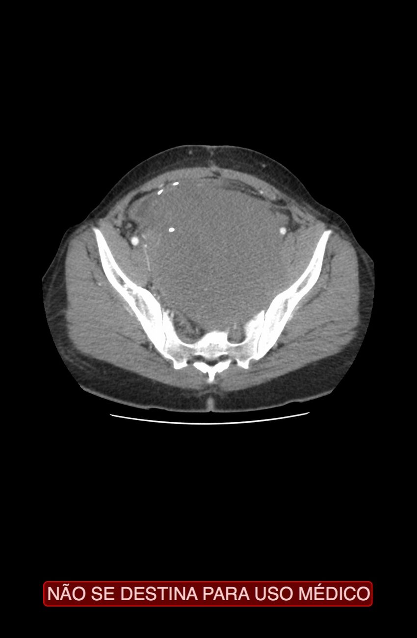 Abdominal desmoid tumor (Radiopaedia 44024-47540 Axial C+ arterial phase 38).jpg