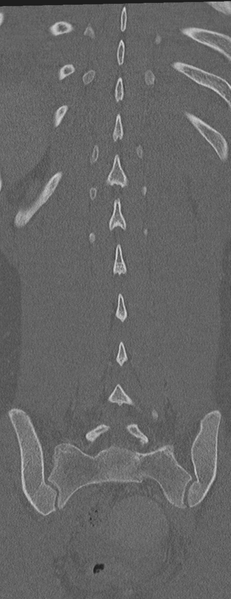 File:Abdominal multi-trauma - devascularised kidney and liver, spleen and pancreatic lacerations (Radiopaedia 34984-36486 Coronal bone window 54).png