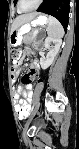 File:Abdominal wall and retroperitoneal tuberculosis (Radiopaedia 88137-104729 Sagittal C+ portal venous phase 53).jpg