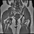 Abdominal wall endometriosis (Radiopaedia 83702-98847 Coronal T1 13).jpg