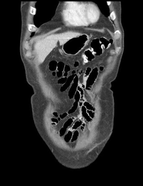 File:Abdominal wall metastasis from colorectal carcinoma (Radiopaedia 31016-31717 Coronal C+ portal venous phase 8).jpg