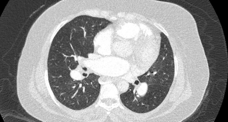 File:Accessory right inferior hepatic vein (Radiopaedia 65245-74259 Axial lung window 39).jpg
