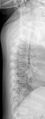 Achondroplasia (Radiopaedia 9294-9979 D 3).jpg