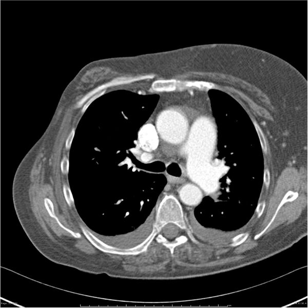 File:Acute-on-chronic pulmonary emboli (Radiopaedia 27925-28169 C+ CTPA 31).jpg