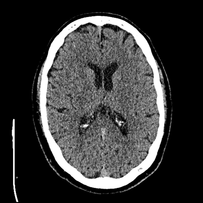 Acute A3 occlusion with ACA ischemic penumbra (CT perfusion) (Radiopaedia 72036-82525 Axial non-contrast thins 48).jpg