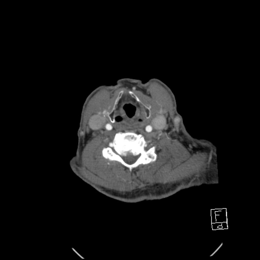 Acute ICA ischemic penumbra due to high-grade CCA stenosis (CT perfusion) (Radiopaedia 72038-82530 Axial C+ arterial phase 53).jpg