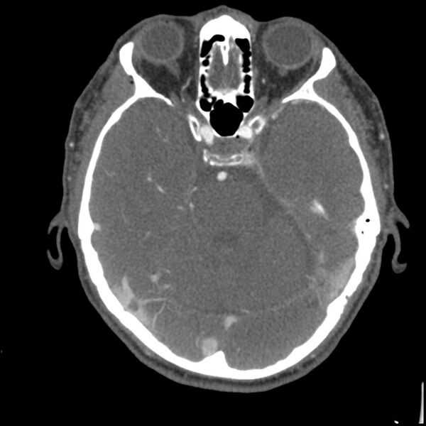 File:Acute P1 occlusion with PCA ischemia penumbra (CT perfusion) (Radiopaedia 72084-82587 Axial C+ arterial thins 61).jpg