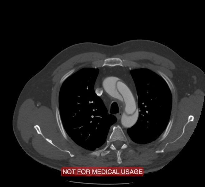 File:Acute aortic dissection - Stanford type A (Radiopaedia 40661-43285 Axial C+ arterial phase 8).jpg