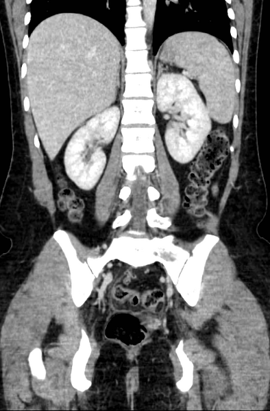 File:Acute appendicitis (Radiopaedia 22892-22918 Coronal C+ portal venous phase 37).png