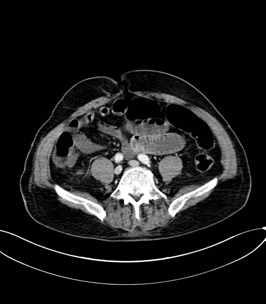 Acute arterial mesenteric ischemia (Radiopaedia 78238-90828 Axial C+ portal venous phase 95).jpg