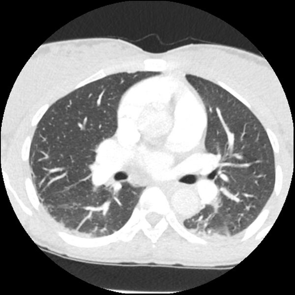 File:Acute chest syndrome - sickle cell disease (Radiopaedia 42375-45499 Axial lung window 89).jpg
