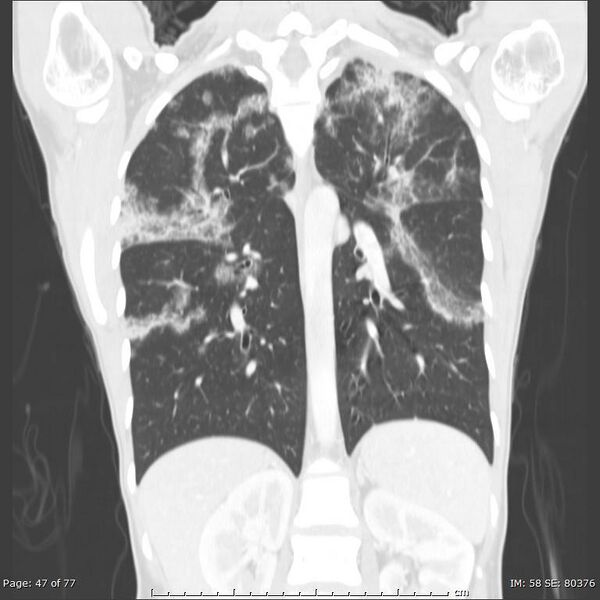 File:Acute eosinophilic pneumonia (Radiopaedia 48211-53073 Coronal 12).jpg