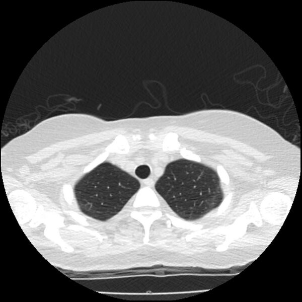 File:Acute interstitial pneumonitis (Radiopaedia 45404-49444 Axial lung window 14).jpg
