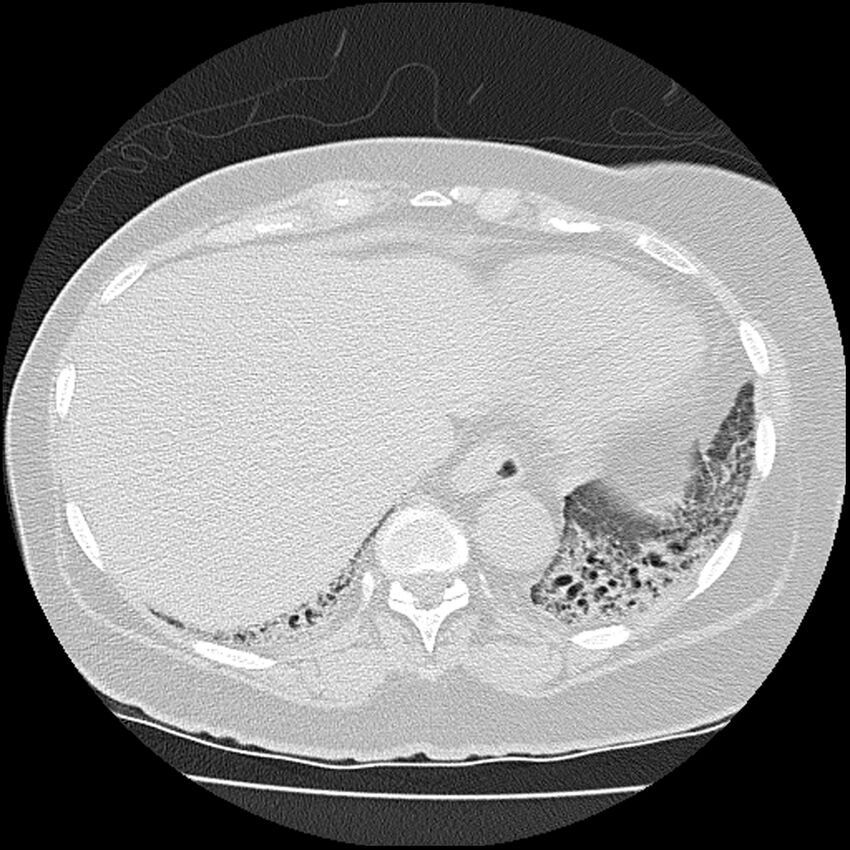Acute interstitial pneumonitis (Radiopaedia 45404-49452 Axial lung window 76).jpg