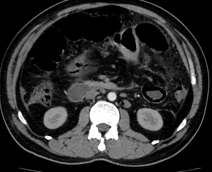 File:Acute mesenteric ischemia - superior mesenteric artery thrombosis (Radiopaedia 73947-84776 Axial C+ arterial phase 50).jpg