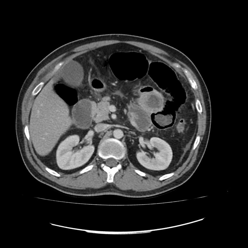 Acute mesenteric ischemia - superior mesenteric artery thrombosis (Radiopaedia 73947-84776 Axial C+ portal venous phase 35).jpg