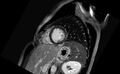 Acute myocarditis (Radiopaedia 77023-88967 Short axis stack LGE 5).jpg