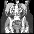 Acute pancreatitis (Radiopaedia 19136-19117 Coronal C+ portal venous phase 28).jpg