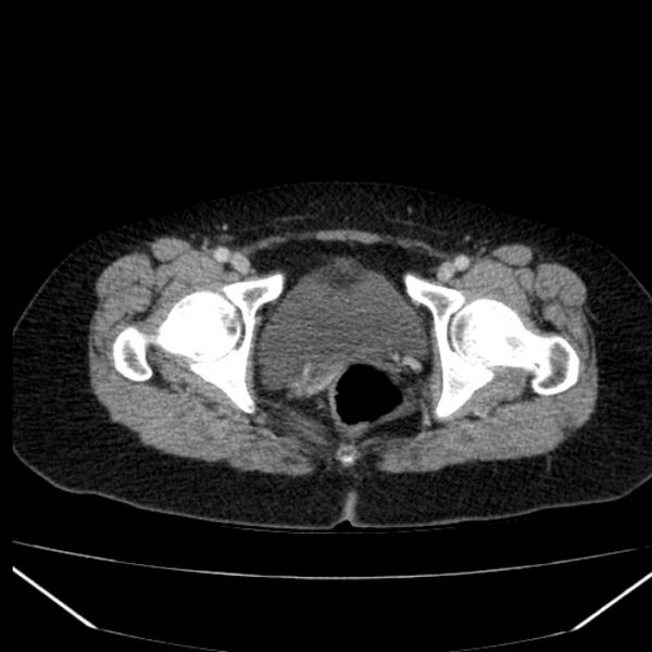File:Acute pancreatitis - Balthazar C (Radiopaedia 26569-26714 Axial C+ portal venous phase 92).jpg