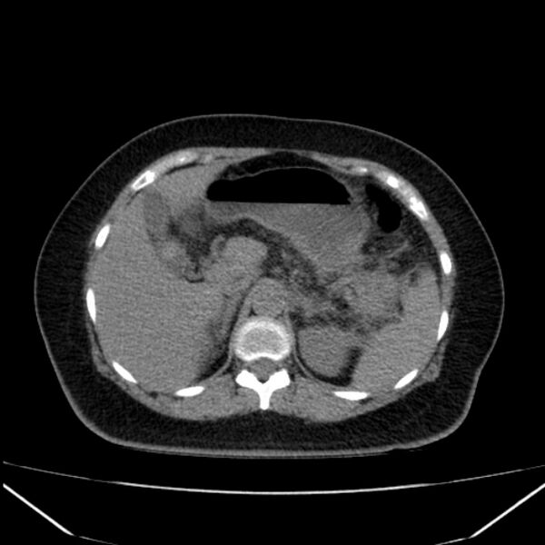 File:Acute pancreatitis - Balthazar C (Radiopaedia 26569-26714 Axial non-contrast 29).jpg