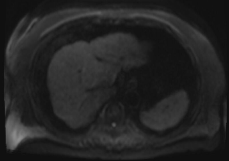 File:Acute portal vein thrombosis (Radiopaedia 73198-83925 Axial DWI 39).jpg