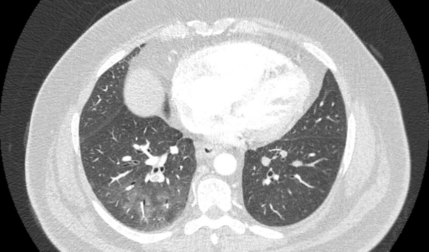 Acute pulmonary embolism with pulmonary infarcts (Radiopaedia 77688-89908 Axial lung window 84).jpg