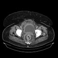 Acute pyelonephritis (Radiopaedia 25657-25837 Axial renal parenchymal phase 74).jpg