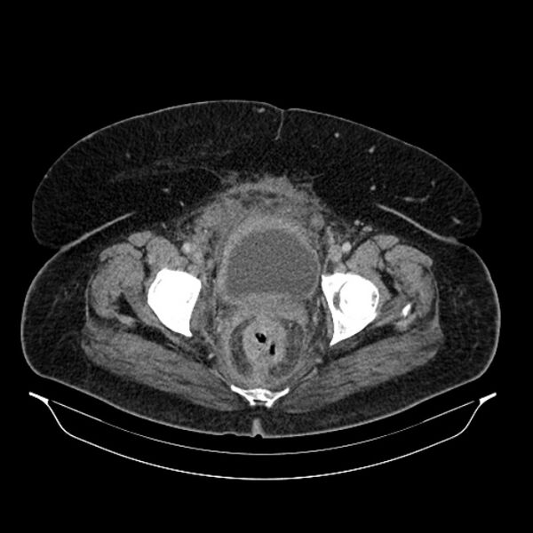 File:Acute pyelonephritis (Radiopaedia 25657-25837 Axial renal parenchymal phase 74).jpg