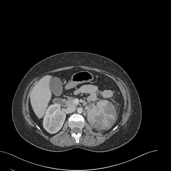 File:Acute pyelonephritis with renal vein thrombosis (Radiopaedia 58020-65053 Axial renal parenchymal phase 52).jpg