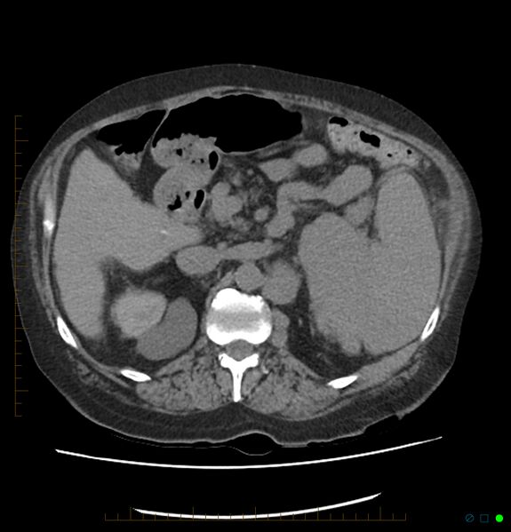 File:Acute renal failure post IV contrast injection- CT findings (Radiopaedia 47815-52559 Axial C+ portal venous phase 29).jpg