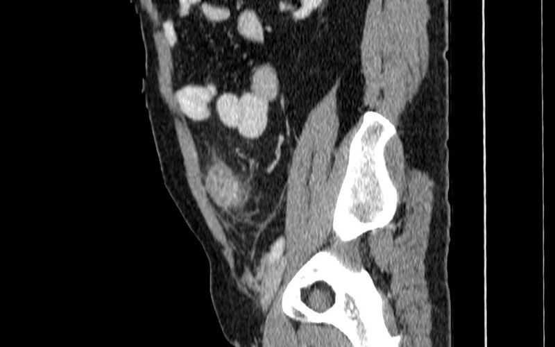 File:Acute sigmoid colon diverticulitis (Radiopaedia 55507-61976 Sagittal C+ portal venous phase 71).jpg