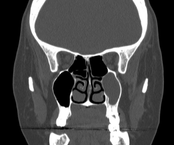 File:Acute sinusitis (Radiopaedia 22419-22455 Coronal bone window 22).jpg