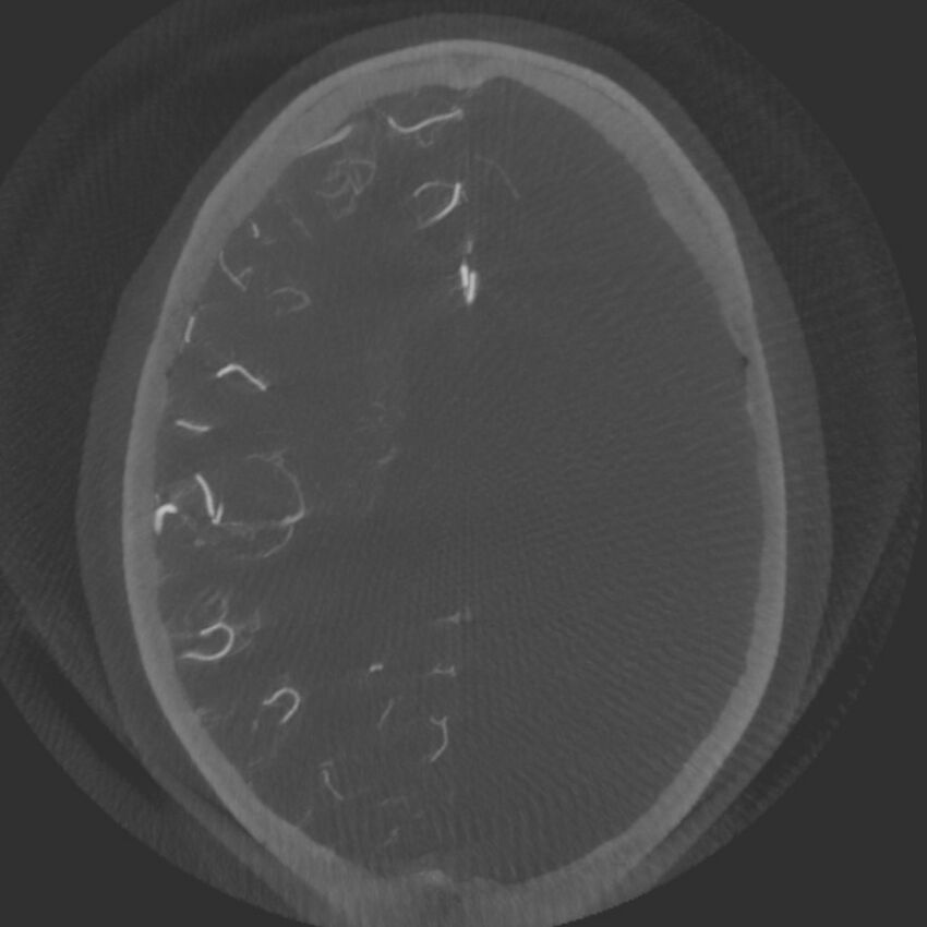 Acute subarachnoid hemorrhage and accessory anterior cerebral artery (Radiopaedia 69231-79010 Axial arterial - MIP 52).jpg