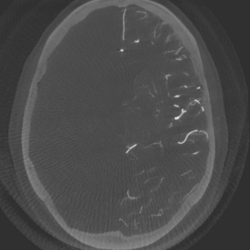 Acute subarachnoid hemorrhage and accessory anterior cerebral artery (Radiopaedia 69231-79010 C 36).jpg