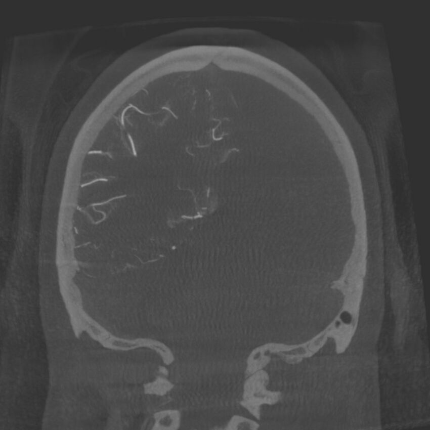 Acute subarachnoid hemorrhage and accessory anterior cerebral artery (Radiopaedia 69231-79010 Coronal arterial - MIP 76).jpg
