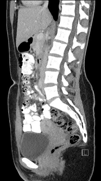 File:Acute uncomplicated appendicitis (Radiopaedia 61374-69304 Sagittal C+ portal venous phase 53).jpg