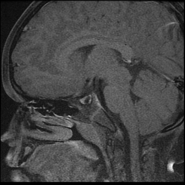 File:Adamantinomatous craniopharyngioma (Radiopaedia 77407-89529 Sagittal T1 C+ fat sat 6).jpg