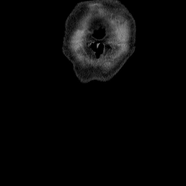 File:Adenocarcinoma of colon with entero-colic fistula (Radiopaedia 22832-22852 Coronal C+ portal venous phase 3).jpg